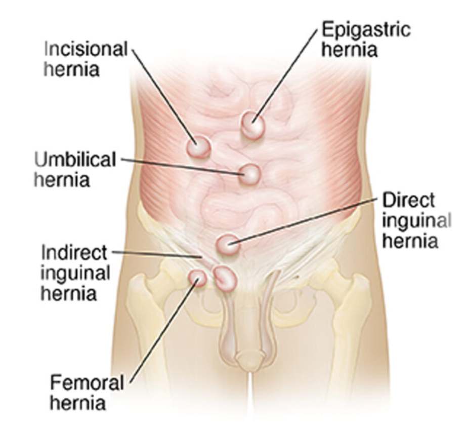 Hernia Surgery